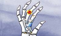 Arthrose Une maladie loin des idées reçues