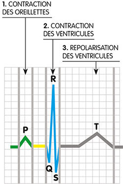 Tracé électrocardiogramme Tracé électrocardiogramme